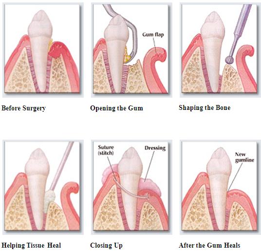 Facial flap surgery